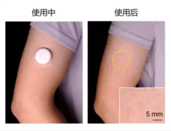 浙大团队研发痛感零的贴敷式输液贴：告别疼痛，迎接无线挂盐新时代
