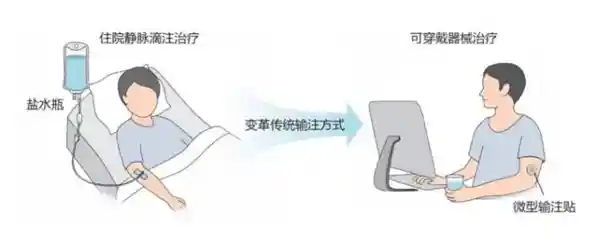 浙大团队研发痛感零的贴敷式输液贴：告别疼痛，迎接无线挂盐新时代