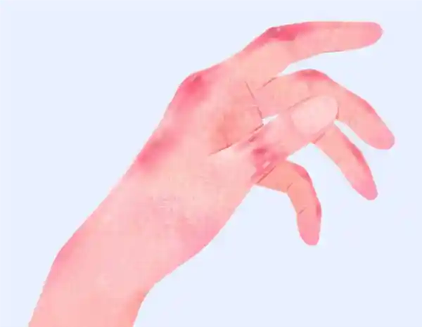 冬季专属疾病：寒冷季节痒痛双袭