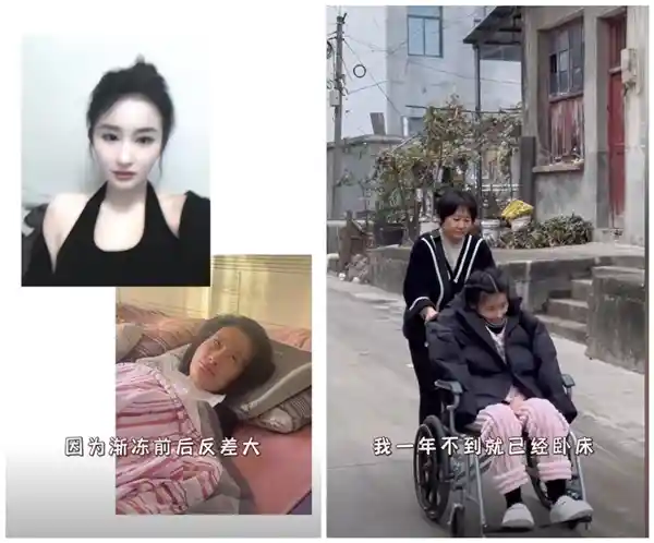 女生渐冻症患者一年间惨变：吞咽成难题，容颜骤变