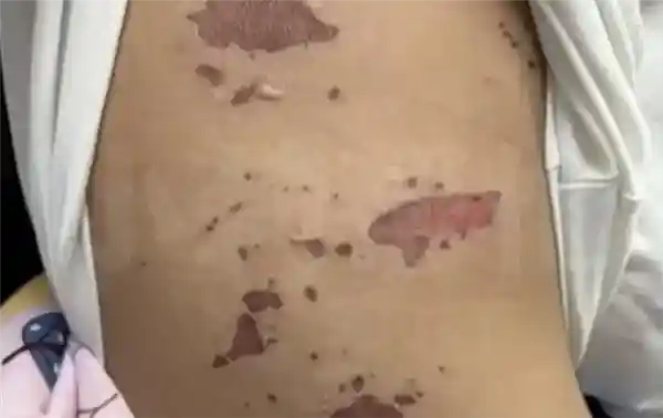 3岁男童火锅烫伤全身溃烂！医生警告：疑似传染性灾难！