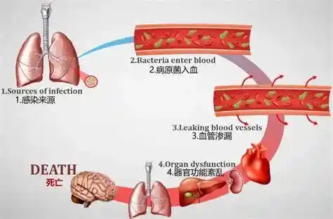 揭秘大S逝因：败血症与肺炎勾结，致命风险高达60％！