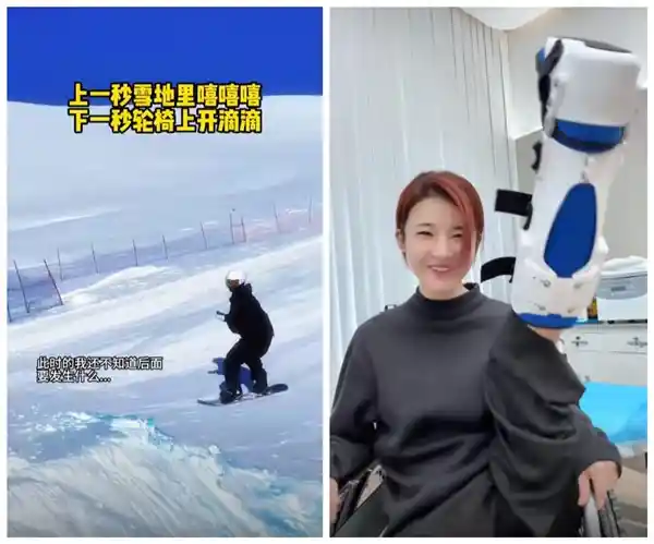 百万粉丝网红滑雪意外骨折，医学奇迹：体内植入24颗钉子的震撼治疗