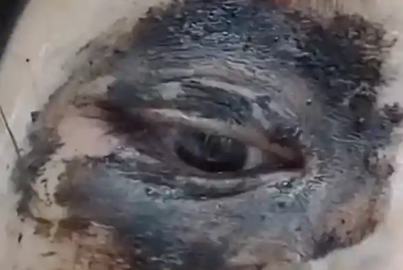 《女子误触隐翅虫不洗手竟致眼周红肿爆痘，警惕这种致命小虫！》