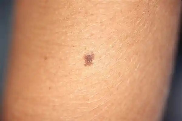 警惕！这5种痣可能癌变，发现一个都得重视