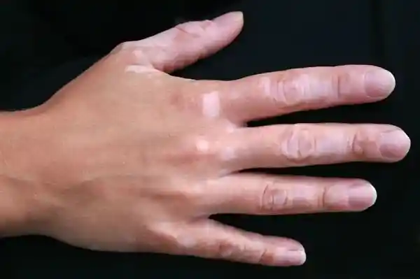身上突然白了一块，竟是身体发出的危险信号？
